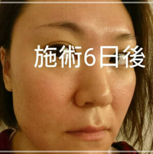 ビフォーアフター バービーの肌が綺麗になった 治療額は1000万超え お笑い芸能headline