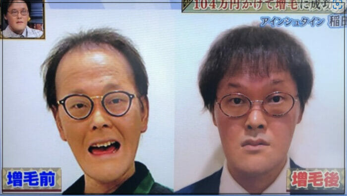 アインシュタイン稲田の魚鱗癬
